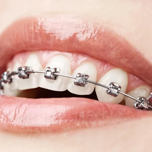 dental-braces-01