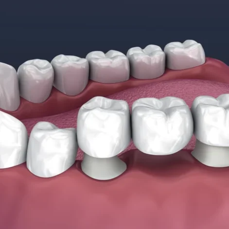dental-bridge