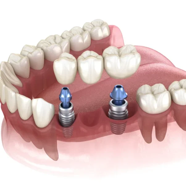 dental-implants-02
