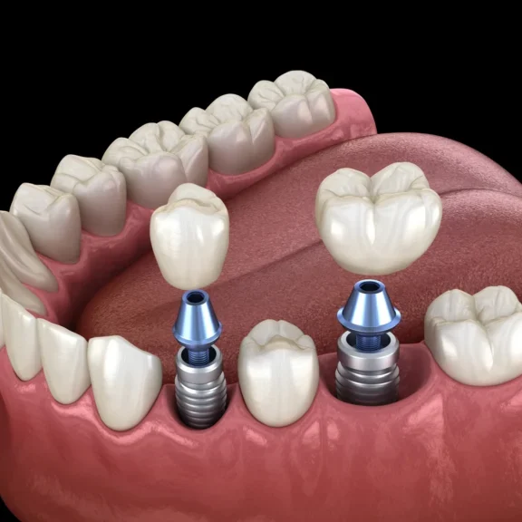 dental-implants