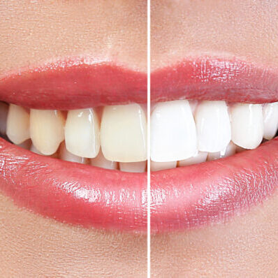 Demonstration of dental whitening result, before and after procedure. Dentistry concept.
